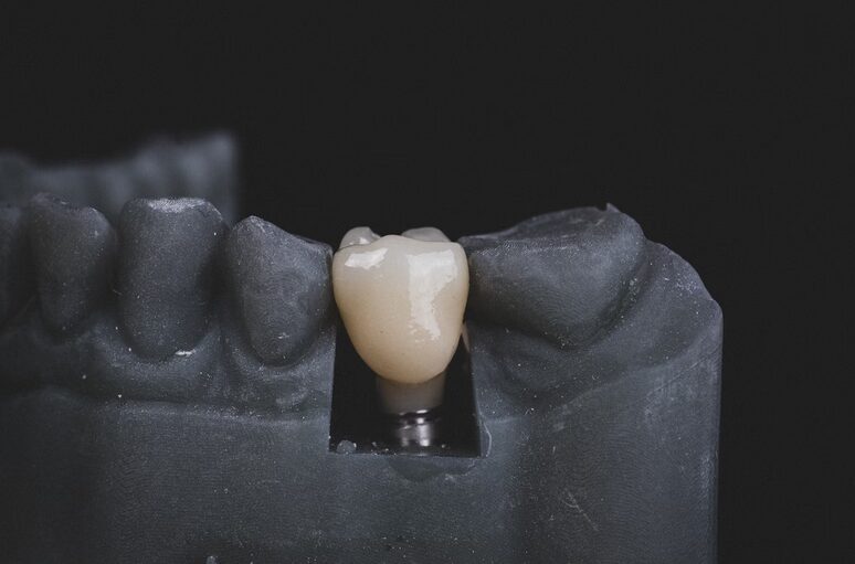 tooth implant